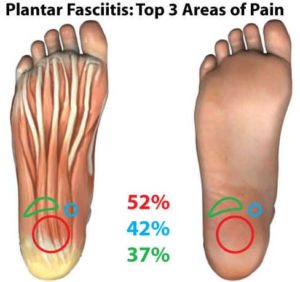 plantar-fasciitis-pain-map